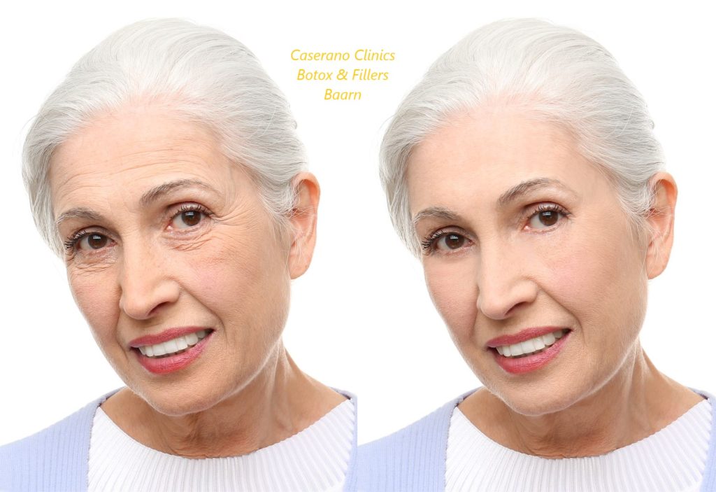 Caserano Botox behandeling voor- en na